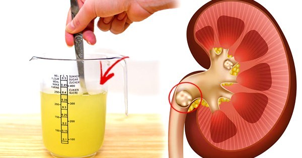 ingredient prevent kidney stones